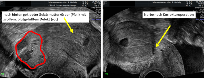 Sectio-Scar-Repair (Bild: Prof. Dr. Angela Köninger)